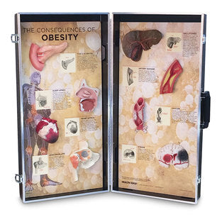 CONSEQUENCES OF OBESITY