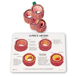 4-Piece Artery Model – Atherosclerosis Demonstration