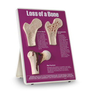 LOSS OF A BONE